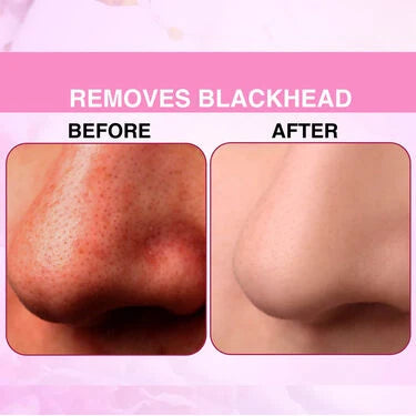 Instant Blackhead Remover Vacuum Suction Device (BVD)