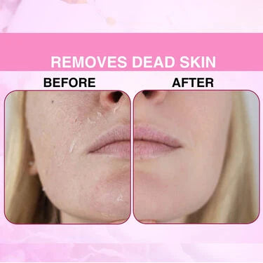 Instant Blackhead Remover Vacuum Suction Device (BVD)