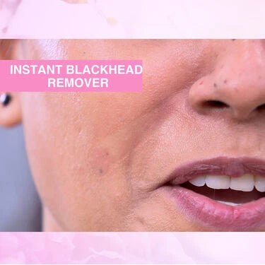 Instant Blackhead Remover Vacuum Suction Device (BVD)