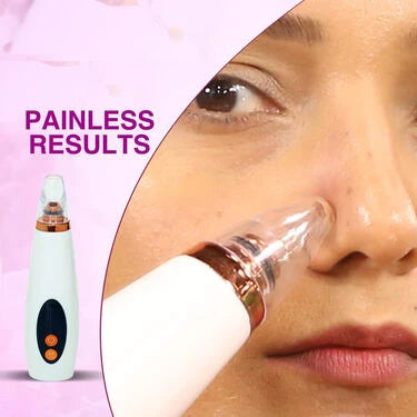 Instant Blackhead Remover Vacuum Suction Device (BVD)